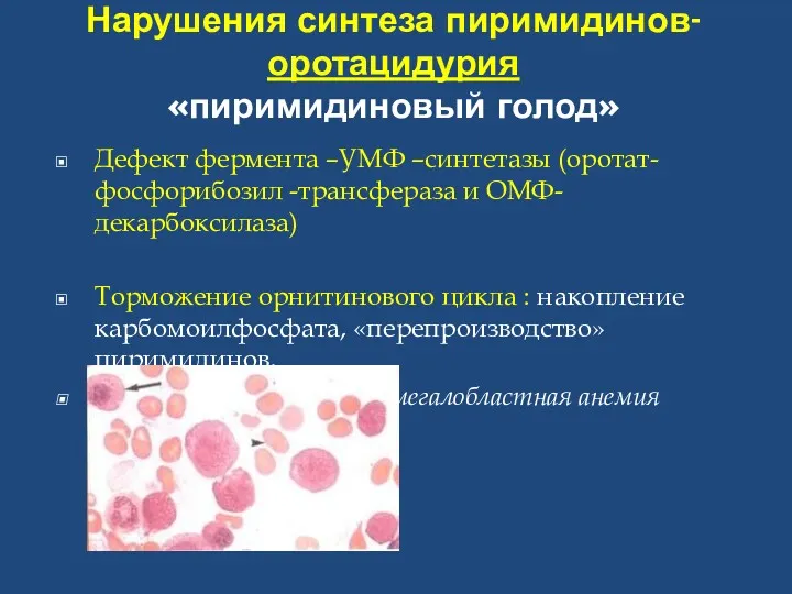 Нарушения синтеза пиримидинов- оротацидурия «пиримидиновый голод» Дефект фермента –УМФ –синтетазы