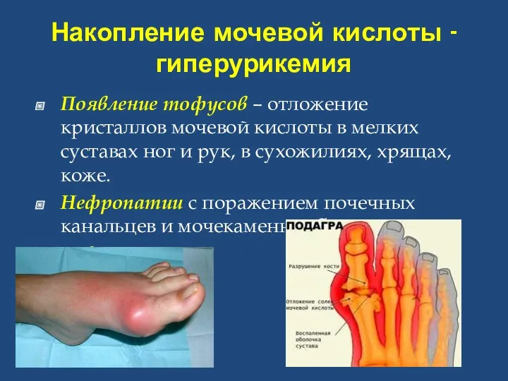 Накопление мочевой кислоты -гиперурикемия Появление тофусов – отложение кристаллов мочевой
