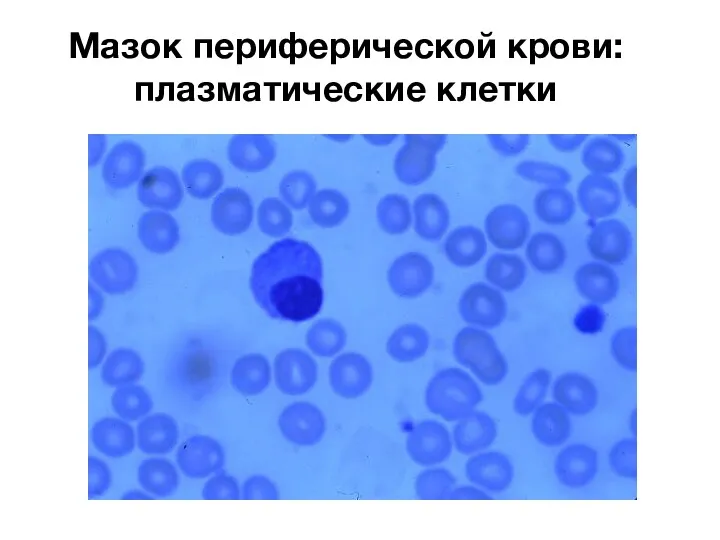 Мазок периферической крови: плазматические клетки