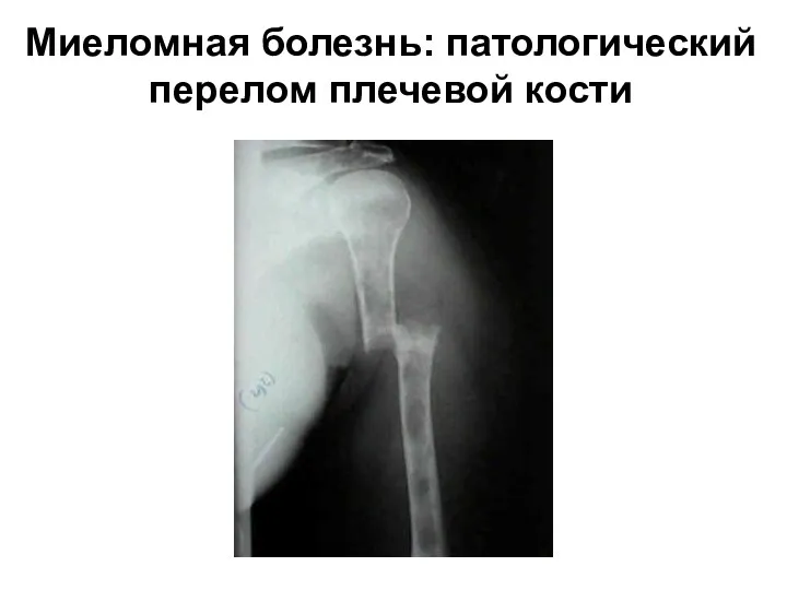 Миеломная болезнь: патологический перелом плечевой кости