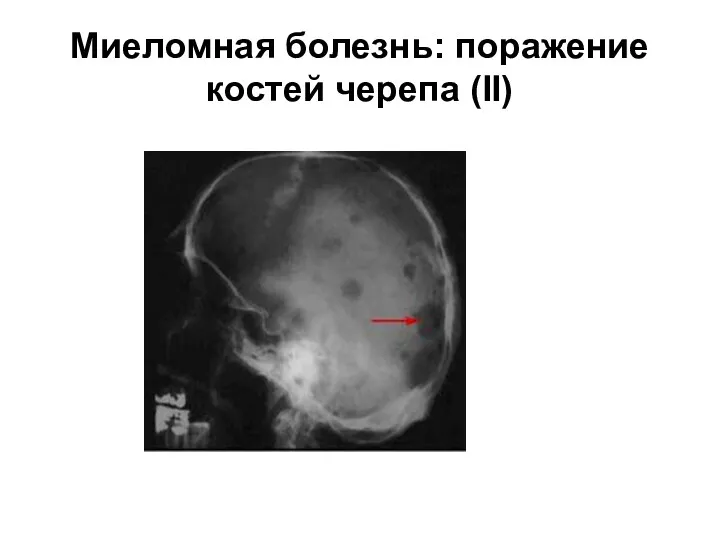 Миеломная болезнь: поражение костей черепа (II)