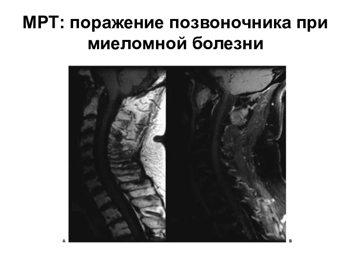 МРТ: поражение позвоночника при миеломной болезни