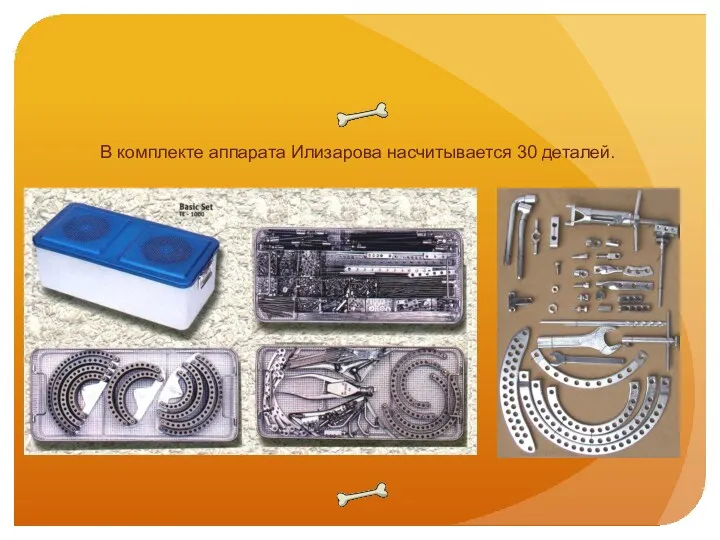 В комплекте аппарата Илизарова насчитывается 30 деталей.