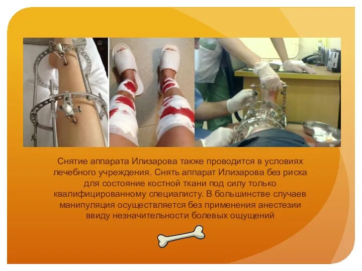 Снятие аппарата Илизарова также проводится в условиях лечебного учреждения. Снять аппарат Илизарова без