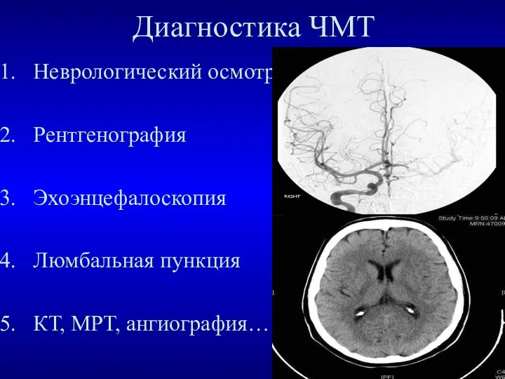 Диагностика ЧМТ Неврологический осмотр Рентгенография Эхоэнцефалоскопия Люмбальная пункция КТ, МРТ, ангиография…