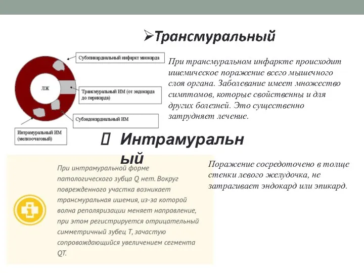 При трансмуральном инфаркте происходит ишемическое поражение всего мышечного слоя органа.