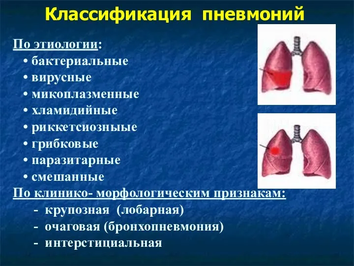 Классификация пневмоний По этиологии: • бактериальные • вирусные • микоплазменные