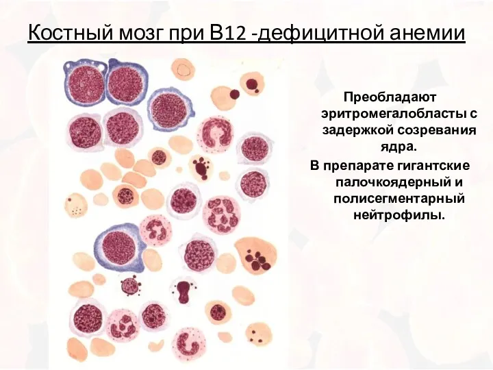 Костный мозг при В12 -дефицитной анемии Преобладают эритромегалобласты с задержкой