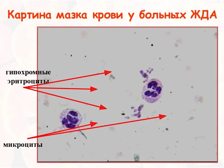 Картина мазка крови у больных ЖДА микроциты гипохромные эритроциты