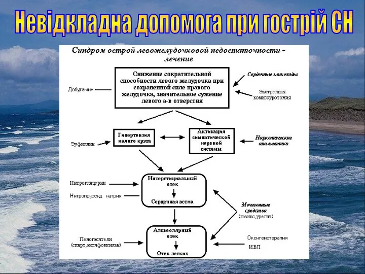 Невідкладна допомога при гострій СН