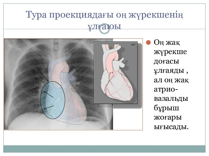 Тура проекциядағы оң жүрекшенің ұлғаюы Оң жақ жүрекше доғасы ұлғаяды