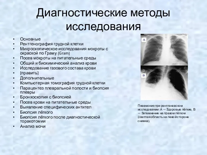 Диагностические методы исследования Основные Рентгенография грудной клетки Микроскопическое исследования мокроты