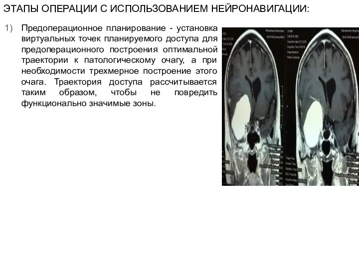 ЭТАПЫ ОПЕРАЦИИ С ИСПОЛЬЗОВАНИЕМ НЕЙРОНАВИГАЦИИ: Предоперационное планирование - установка виртуальных