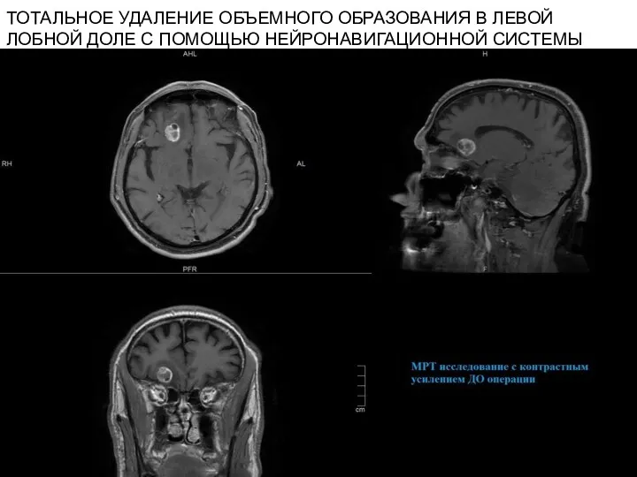 ТОТАЛЬНОЕ УДАЛЕНИЕ ОБЪЕМНОГО ОБРАЗОВАНИЯ В ЛЕВОЙ ЛОБНОЙ ДОЛЕ С ПОМОЩЬЮ НЕЙРОНАВИГАЦИОННОЙ СИСТЕМЫ