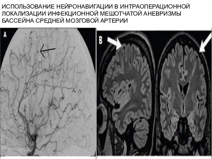 ИСПОЛЬЗОВАНИЕ НЕЙРОНАВИГАЦИИ В ИНТРАОПЕРАЦИОННОЙ ЛОКАЛИЗАЦИИ ИНФЕКЦИОННОЙ МЕШОТЧАТОЙ АНЕВРИЗМЫ БАССЕЙНА СРЕДНЕЙ МОЗГОВОЙ АРТЕРИИ