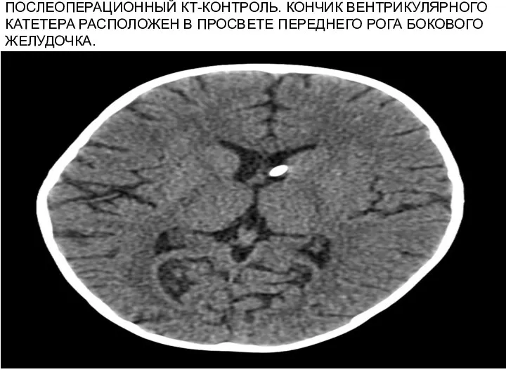 ПОСЛЕОПЕРАЦИОННЫЙ КТ-КОНТРОЛЬ. КОНЧИК ВЕНТРИКУЛЯРНОГО КАТЕТЕРА РАСПОЛОЖЕН В ПРОСВЕТЕ ПЕРЕДНЕГО РОГА БОКОВОГО ЖЕЛУДОЧКА.
