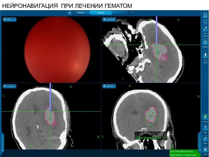 НЕЙРОНАВИГАЦИЯ ПРИ ЛЕЧЕНИИ ГЕМАТОМ