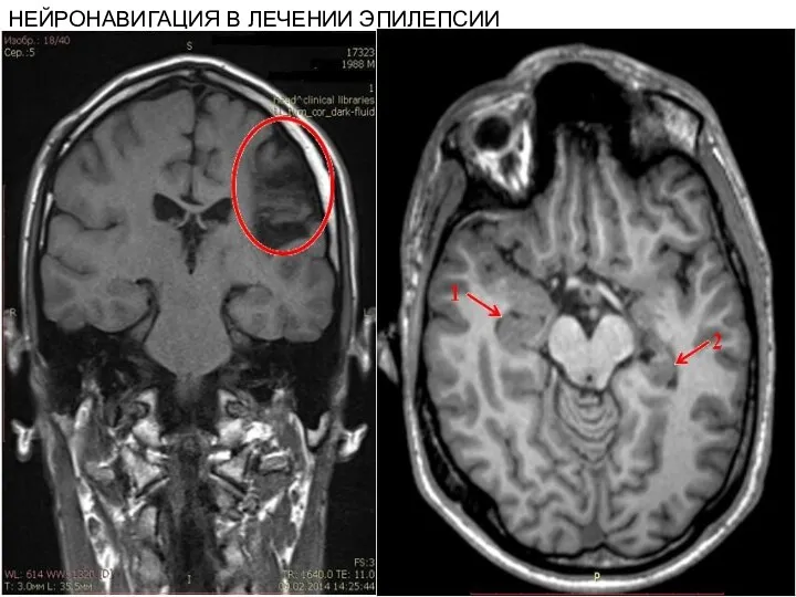 НЕЙРОНАВИГАЦИЯ В ЛЕЧЕНИИ ЭПИЛЕПСИИ