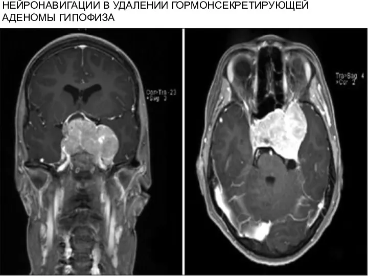 НЕЙРОНАВИГАЦИИ В УДАЛЕНИИ ГОРМОНСЕКРЕТИРУЮЩЕЙ АДЕНОМЫ ГИПОФИЗА