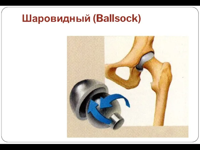 Шаровидный (Ballsock)