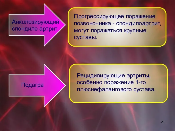 Анкuлозирующий спондило артрит Прогрессирующее поражение позвоночника - спондилоартрит, могут поражаться