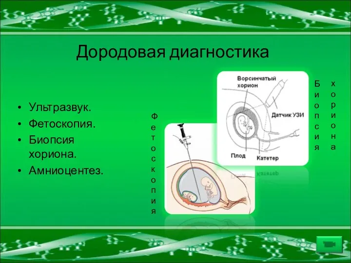 Дородовая диагностика Ультразвук. Фетоскопия. Биопсия хориона. Амниоцентез. Ф е т