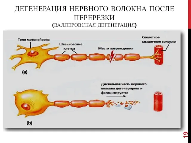 ДЕГЕНЕРАЦИЯ НЕРВНОГО ВОЛОКНА ПОСЛЕ ПЕРЕРЕЗКИ (ВАЛЛЕРОВСКАЯ ДЕГЕНЕРАЦИЯ)