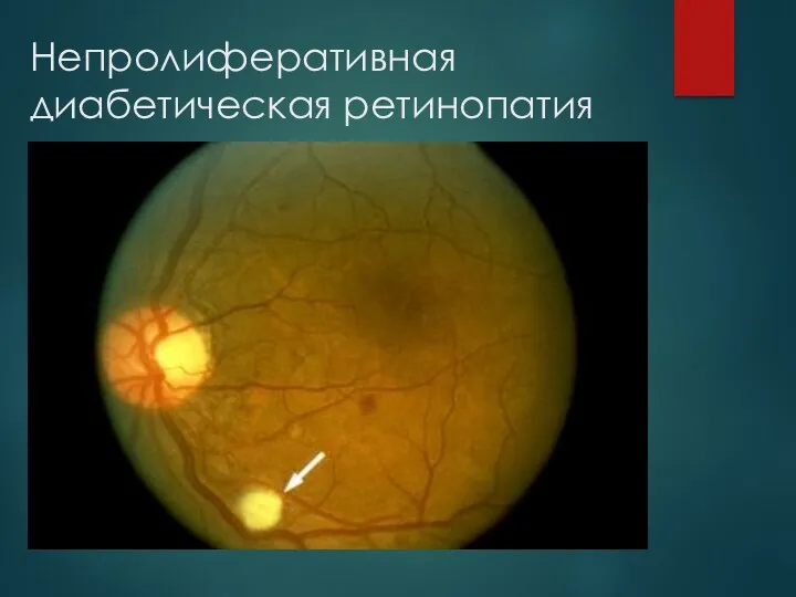 Непролиферативная диабетическая ретинопатия