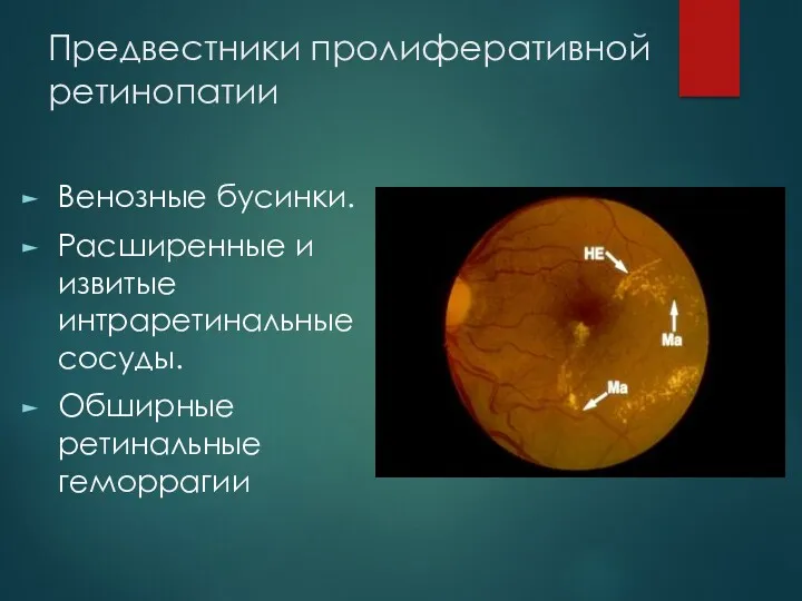Предвестники пролиферативной ретинопатии Венозные бусинки. Расширенные и извитые интраретинальные сосуды. Обширные ретинальные геморрагии