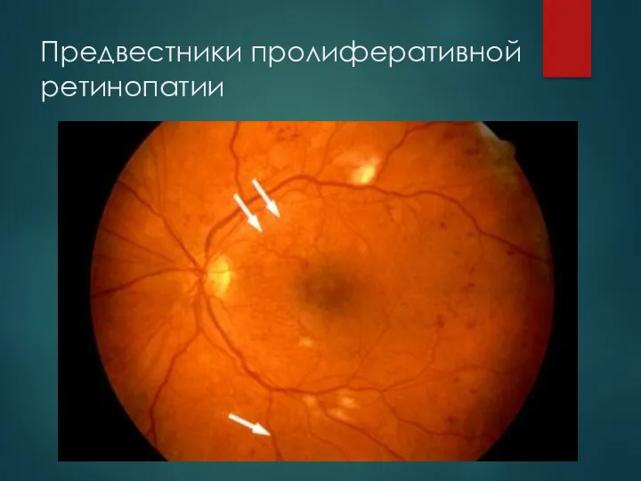 Предвестники пролиферативной ретинопатии