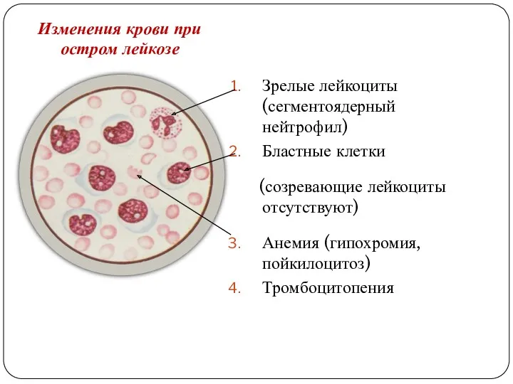 Изменения крови при остром лейкозе Зрелые лейкоциты (сегментоядерный нейтрофил) Бластные
