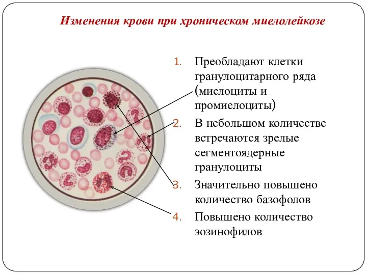 Изменения крови при хроническом миелолейкозе Преобладают клетки гранулоцитарного ряда (миелоциты