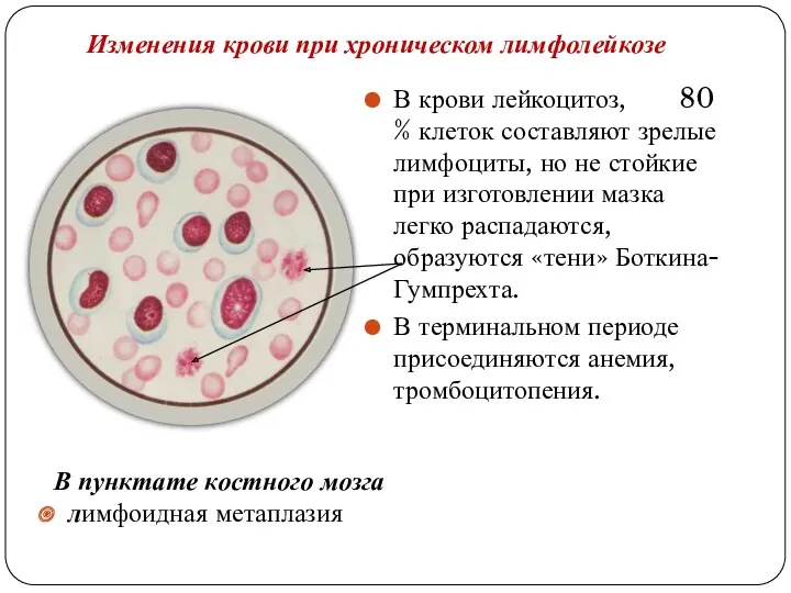Изменения крови при хроническом лимфолейкозе В крови лейкоцитоз, 80 %