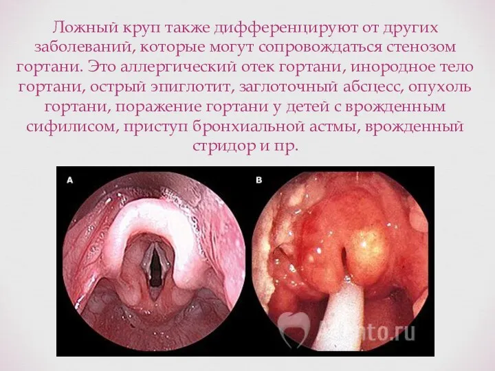 Ложный круп также дифференцируют от других заболеваний, которые могут сопровождаться