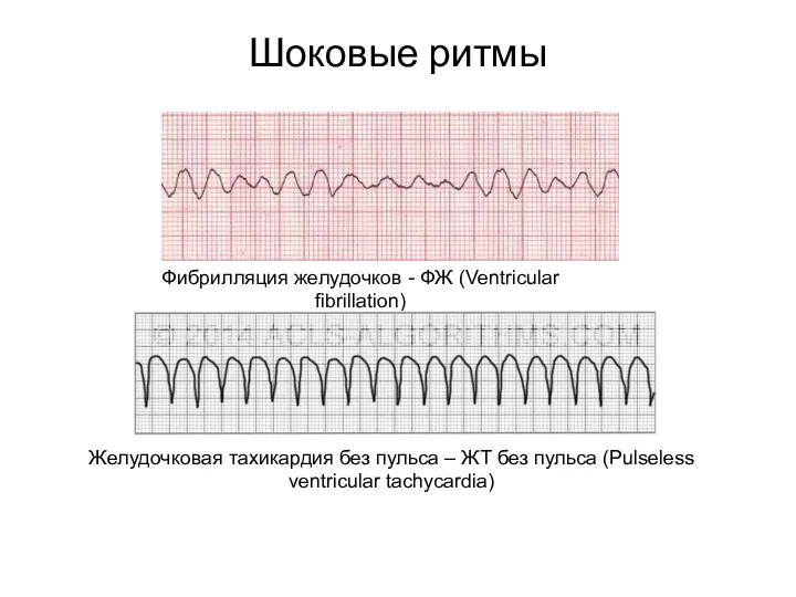 Шоковые ритмы Фибрилляция желудочков - ФЖ (Ventricular fibrillation) Желудочковая тахикардия