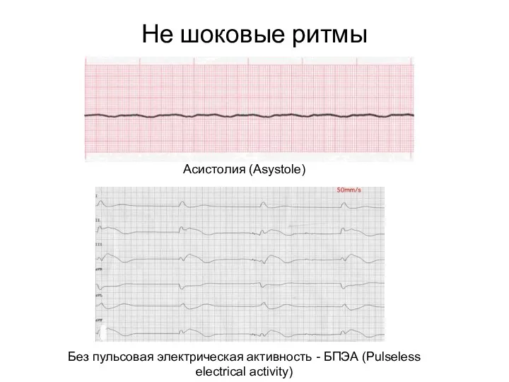 Не шоковые ритмы Без пульсовая электрическая активность - БПЭА (Pulseless electrical activity) Асистолия (Asystole)