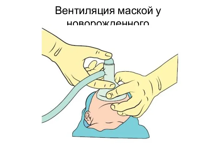 Вентиляция маской у новорожденного