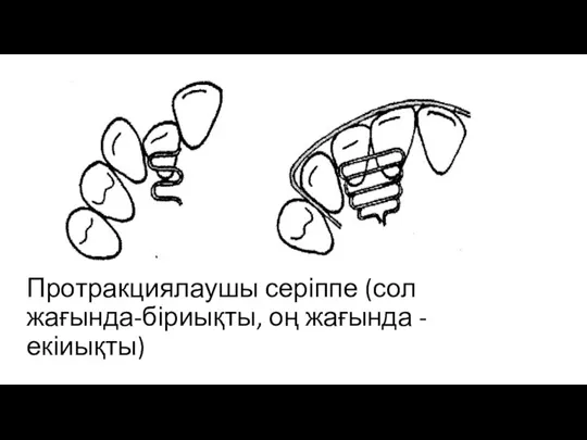 Протракциялаушы серіппе (сол жағында-біриықты, оң жағында - екіиықты)