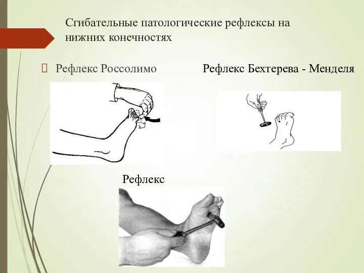 Сгибательные патологические рефлексы на нижних конечностях Рефлекс Россолимо Рефлекс Бехтерева - Менделя Рефлекс Жуковского