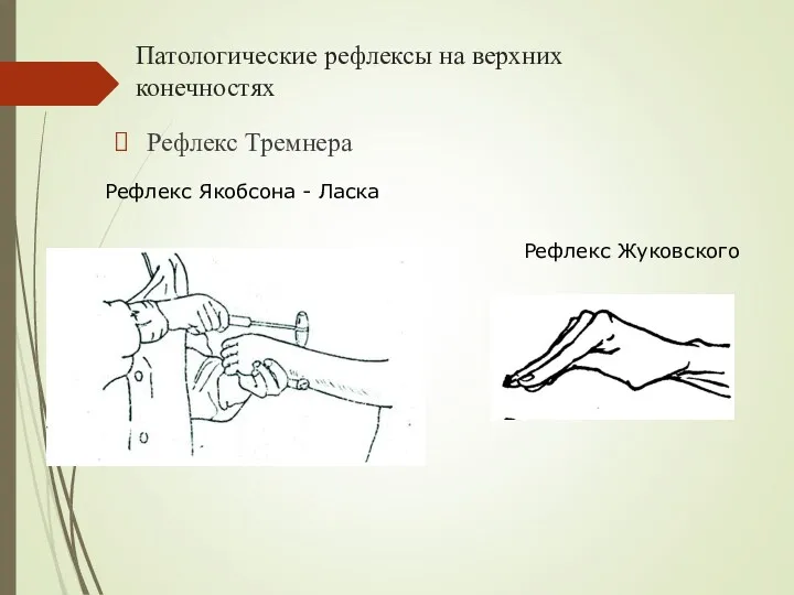 Патологические рефлексы на верхних конечностях Рефлекс Тремнера Рефлекс Якобсона - Ласка Рефлекс Жуковского