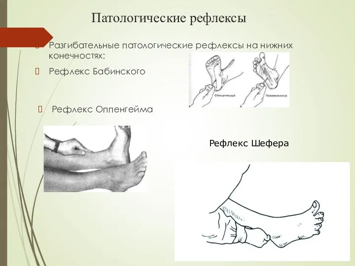 Патологические рефлексы Разгибательные патологические рефлексы на нижних конечностях: Рефлекс Бабинского Рефлекс Оппенгейма Рефлекс Шефера