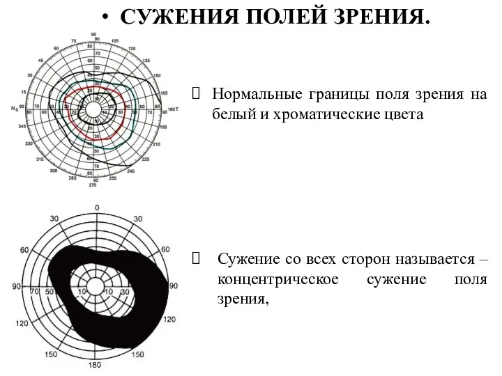 • СУЖЕНИЯ ПОЛЕЙ ЗРЕНИЯ. Сужение со всех сторон называется –