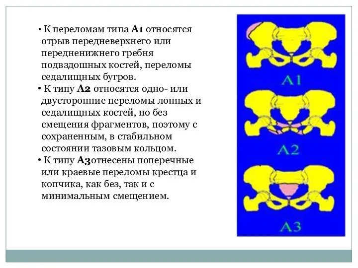 К переломам типа А1 относятся отрыв передневерхнего или передненижнего гребня