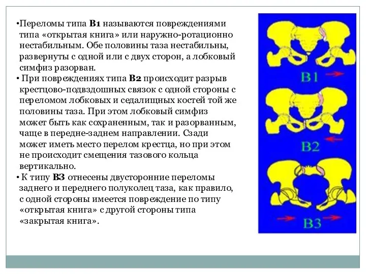 Переломы типа В1 называются повреждениями типа «открытая книга» или наружно-ротационно нестабильным. Обе половины