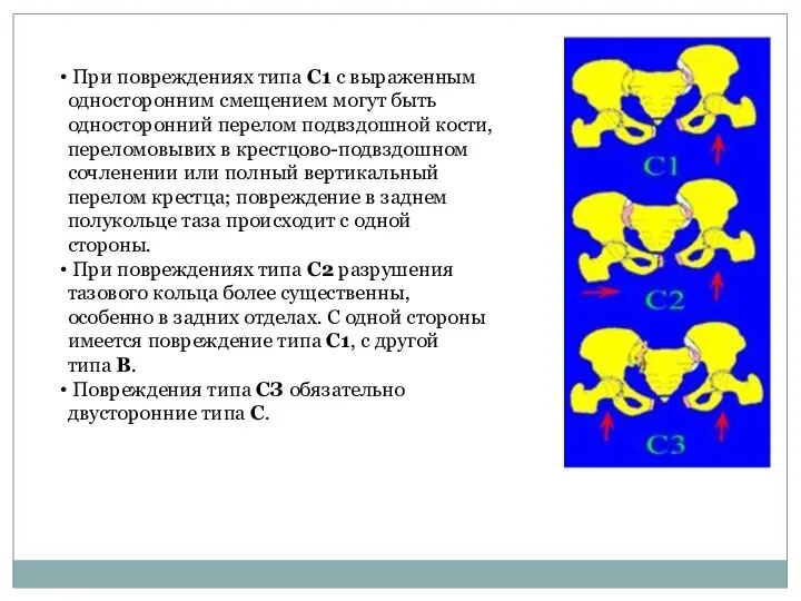 При повреждениях типа С1 с выраженным односторонним смещением могут быть