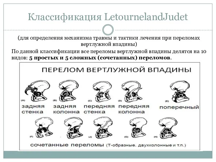 Классификация LetournelandJudet (для определения механизма травмы и тактики лечения при переломах вертлужной впадины)