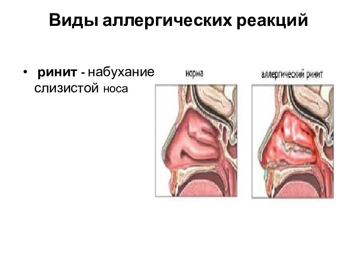 Виды аллергических реакций ринит - набухание слизистой носа