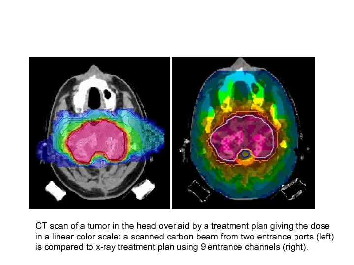 CT scan of a tumor in the head overlaid by