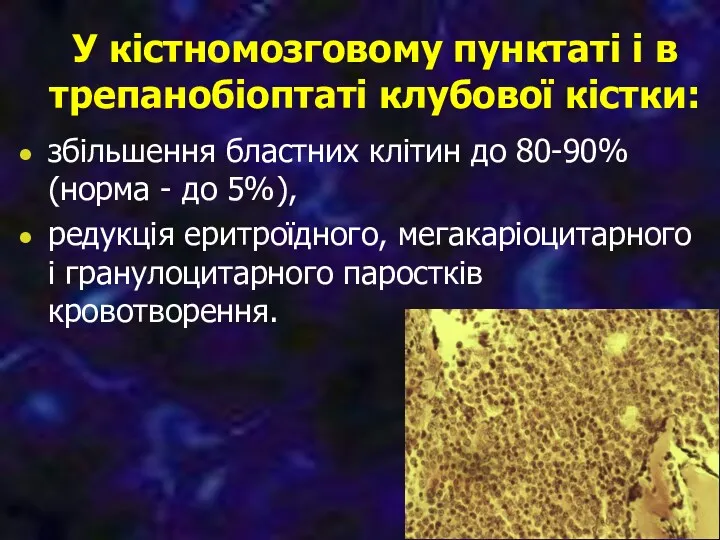 У кістномозговому пунктаті і в трепанобіоптаті клубової кістки: збільшення бластних клітин до 80-90%