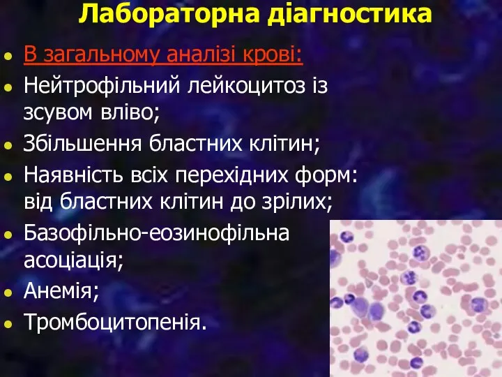 Лабораторна діагностика В загальному аналізі крові: Нейтрофільний лейкоцитоз із зсувом вліво; Збільшення бластних